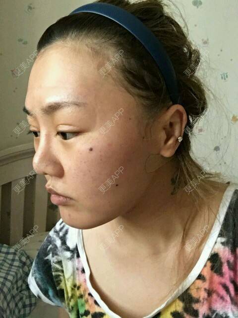 更美 - corinna的吸脂瘦大腿经验 | 大腿吸脂第一周 | 吸脂瘦大腿 | 美购日记 | 重庆