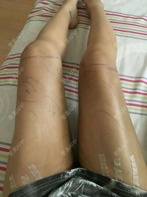 更美 - corinna的吸脂瘦大腿经验 | 大腿吸脂第一周 | 吸脂瘦大腿 | 美购日记 | 重庆