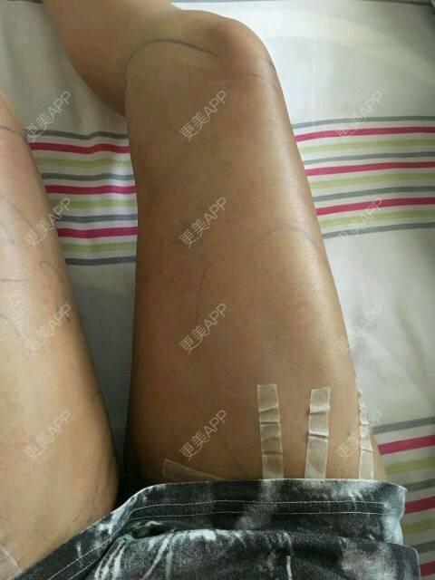 更美 - corinna的吸脂瘦大腿经验 | 大腿吸脂第一周 | 吸脂瘦大腿 | 美购日记 | 重庆