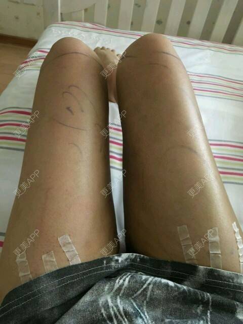 更美 - corinna的吸脂瘦大腿经验 | 大腿吸脂第一周 | 吸脂瘦大腿 | 美购日记 | 重庆