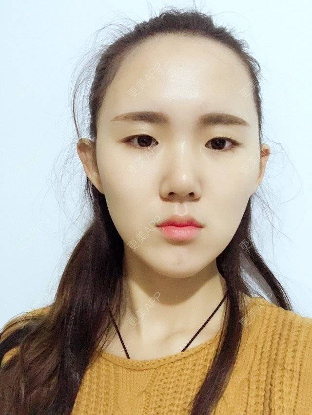 更美 - 李万杰的经验 | 双眼皮 | 滨州