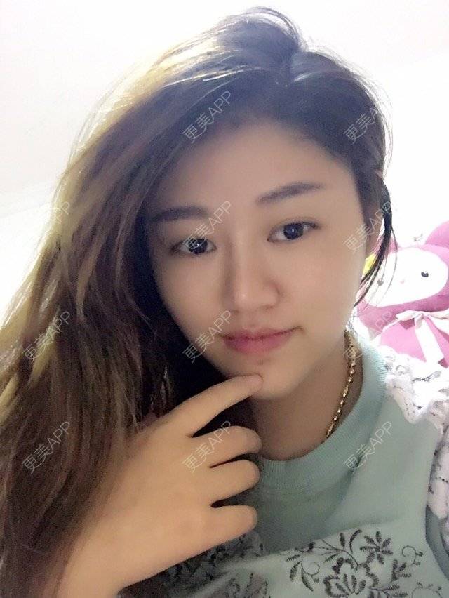 更美 - 更美用户V0ou5xSkIC的玻尿酸下巴经验 | 玻尿酸下巴 | 盐城