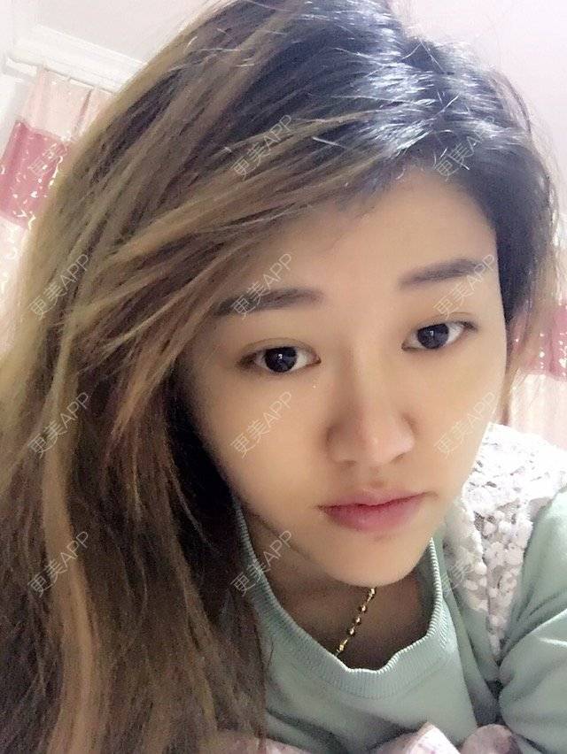 更美 - 更美用户V0ou5xSkIC的玻尿酸下巴经验 | 玻尿酸下巴 | 盐城