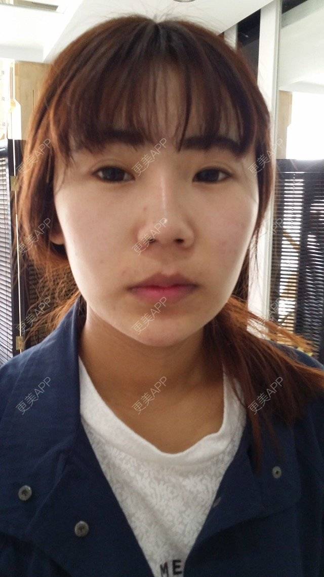 更美 - 小小姐姐的经验 | 美购日记 | 隆鼻假体 | 耳软骨鼻头 | 青岛