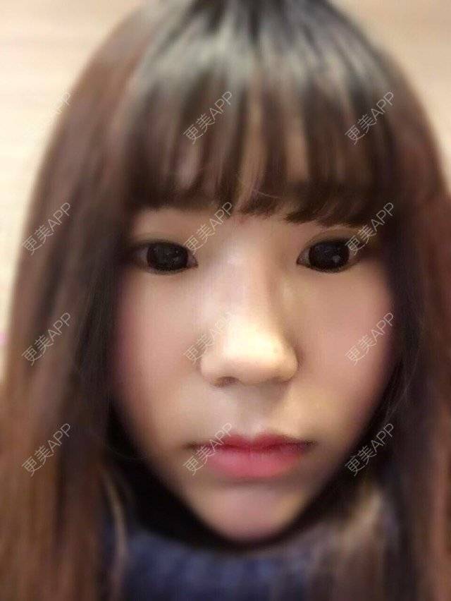 更美 - 小小姐姐的经验 | 美购日记 | 隆鼻假体 | 耳软骨鼻头 | 青岛