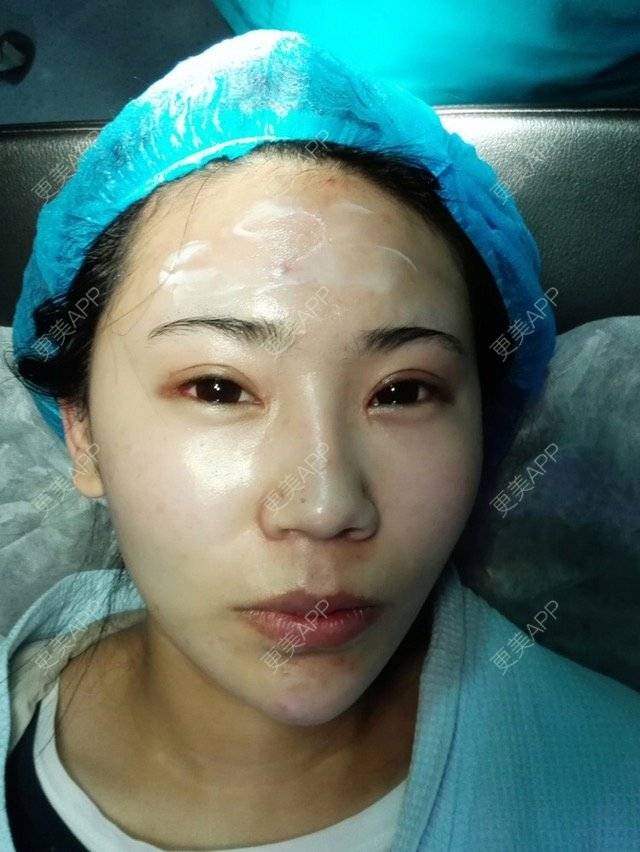 更美 - 小小姐姐的经验 | 美购日记 | 隆鼻假体 | 耳软骨鼻头 | 青岛