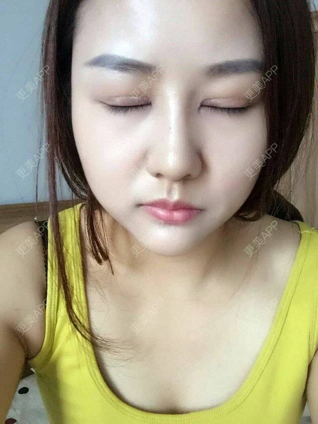 更美 - 最爱汪星人啦的全切双眼皮经验 | 广州 | 隆鼻假体 | 全切双眼皮 | 假体隆下巴