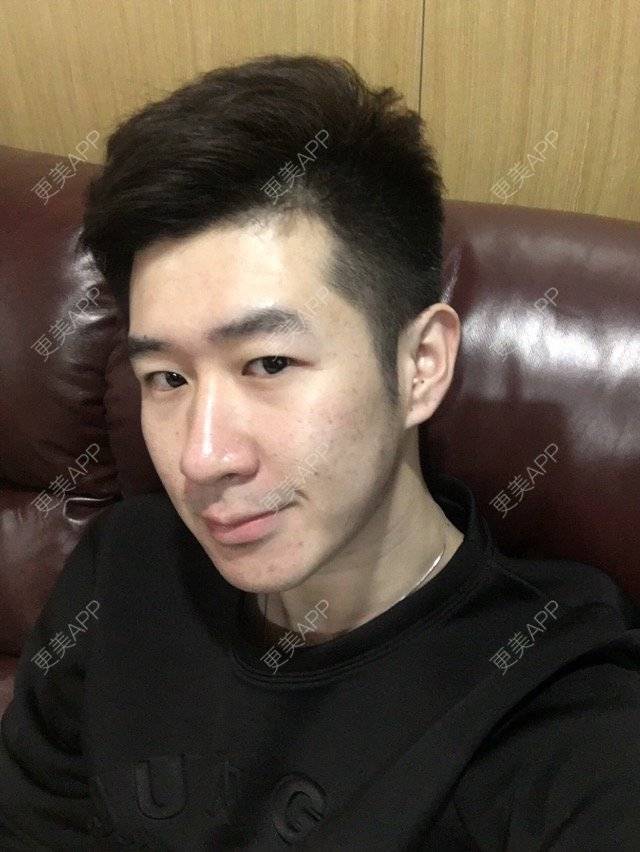 更美 - 成普森的果酸焕肤经验 | 北京 | 祛疤痕痘印 | 果酸焕肤 | 淡化痘印