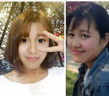 更美 - 土肥圆逆袭小仙女的玻尿酸经验 | 注射美容 | 瘦脸针美白针 | 温州 | 玻尿酸