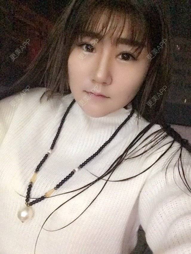 更美 - 最初的小雅的全切双眼皮经验 | 美购日记 | 去颊脂垫 | 切开双眼皮加开眼角 | 埋线双眼皮 | 假体隆下巴 | 南宁 | 视频日记