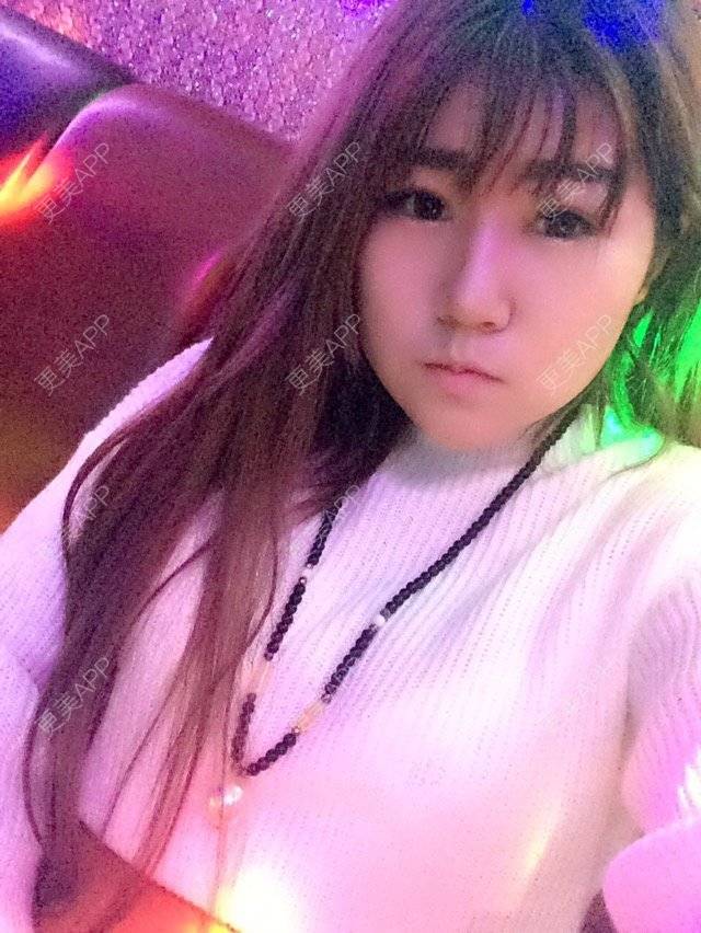 更美 - 最初的小雅的全切双眼皮经验 | 美购日记 | 去颊脂垫 | 切开双眼皮加开眼角 | 埋线双眼皮 | 假体隆下巴 | 南宁 | 视频日记