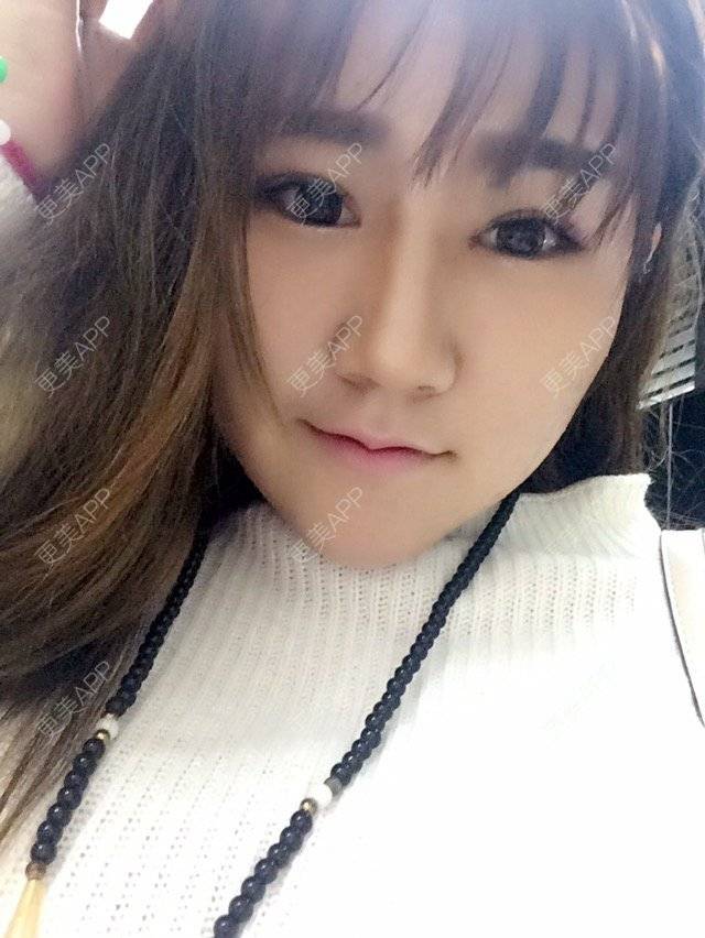 更美 - 最初的小雅的全切双眼皮经验 | 美购日记 | 去颊脂垫 | 切开双眼皮加开眼角 | 埋线双眼皮 | 假体隆下巴 | 南宁 | 视频日记