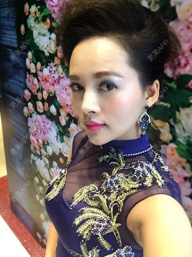 更美 - 武汉艺龄医疗美容医院的切眉经验 | 切眉