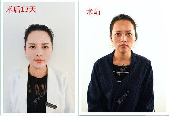 更美 - 武汉艺龄医疗美容医院的埋线提升经验 | 埋线提升