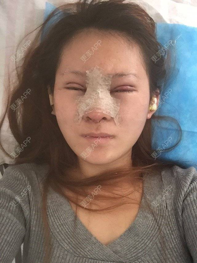 更美 - ✨💃🏻婷儿的膨体隆鼻经验 | 膨体隆鼻 | 玉林