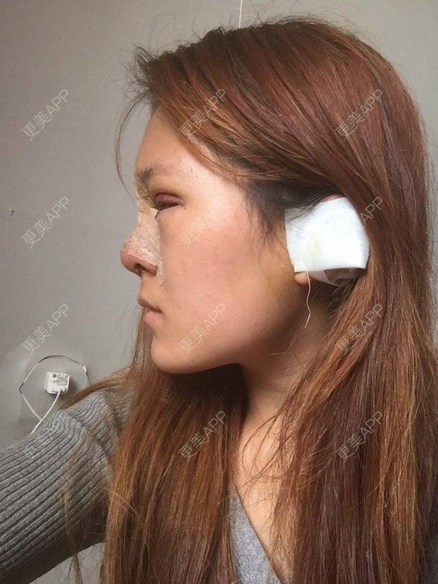 更美 - ✨💃🏻婷儿的膨体隆鼻经验 | 膨体隆鼻 | 玉林