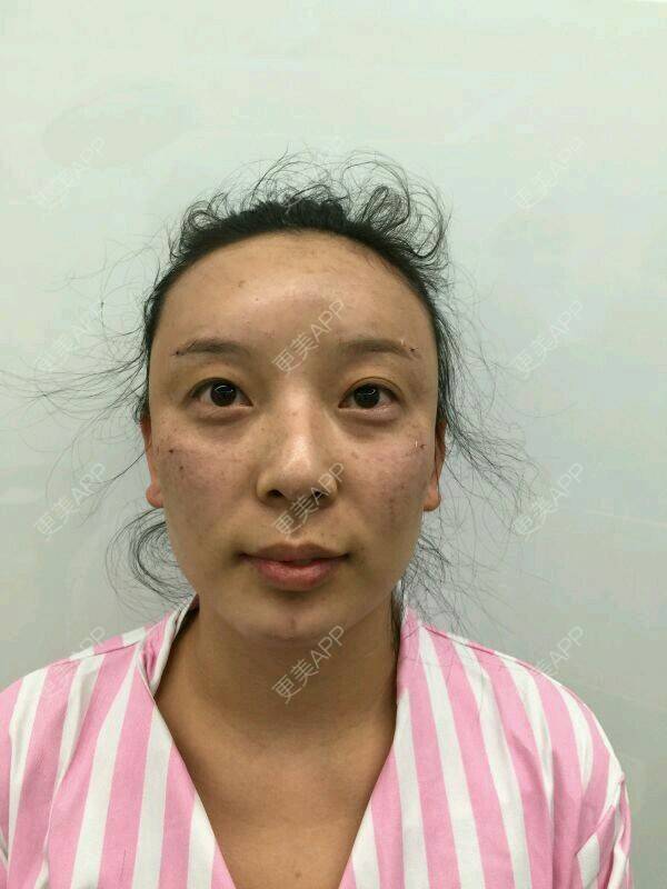 更美 - 阿音是个美人的自体脂肪全面部填充经验 | 北京