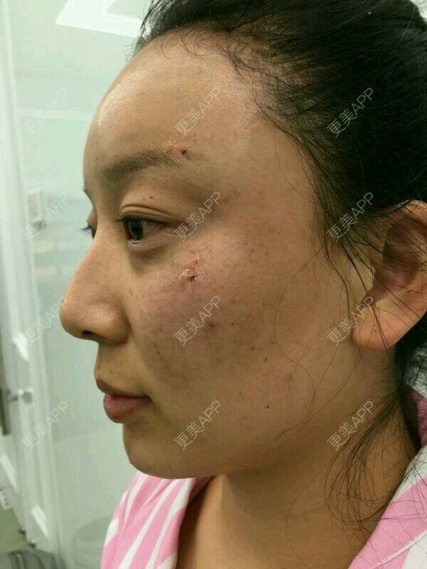 更美 - 阿音是个美人的自体脂肪全面部填充经验 | 北京