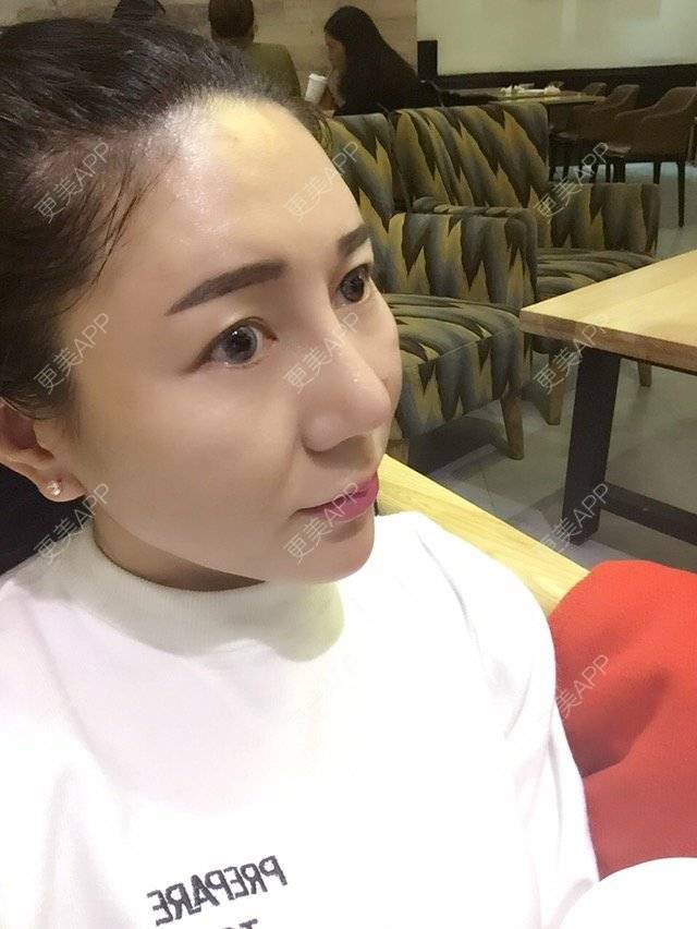更美 - 我在独自等待的经验 | 眼部整形 | 眼皮松弛 | 上睑松弛