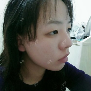鼻骨内推