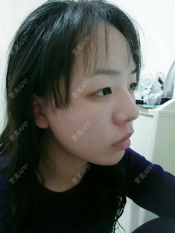 更美 - .。.。.。的经验 | 鼻骨内推 | 长沙