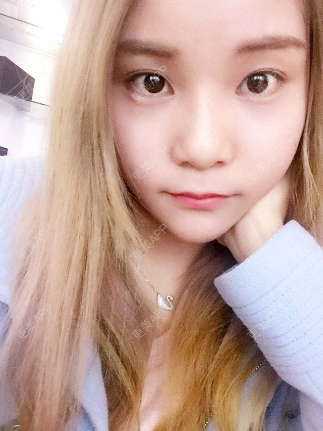 更美 - 喜宝i的冷光美白经验 | 口腔齿科 | 美购日记 | 洁牙 | 冷光美白 | 广州