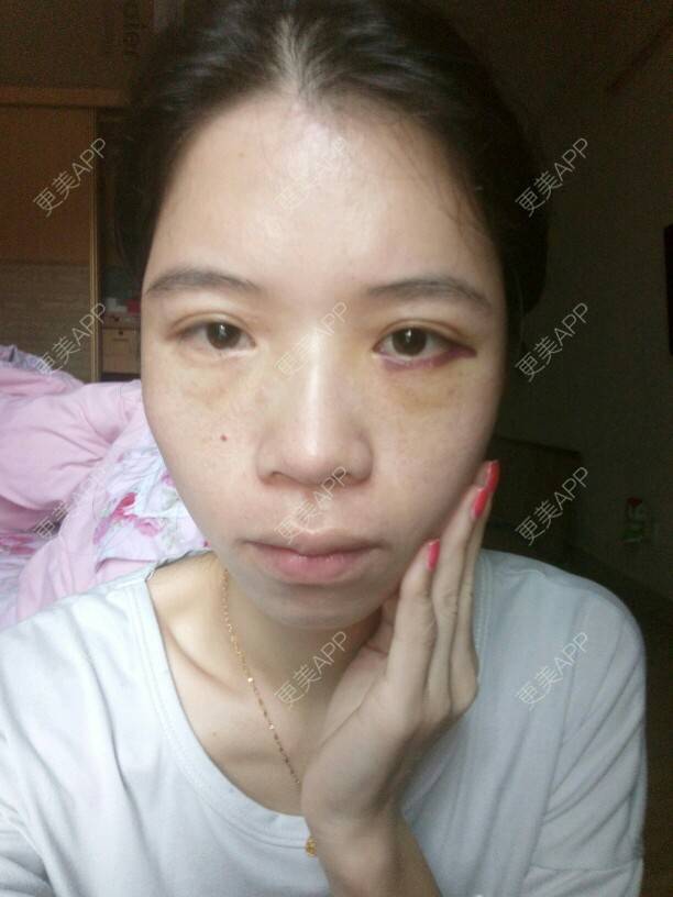 更美 - 心疼妳的心疼。的自体脂肪全面部填充经验 | 热溶脂祛眼袋 | 美购日记 | 自体脂肪全面部填充 | 广州