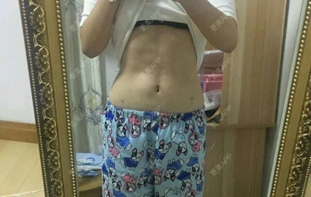 更美 - 金鑫儿的腰腹吸脂经验 | 美购日记 | 腰腹吸脂 | 重庆