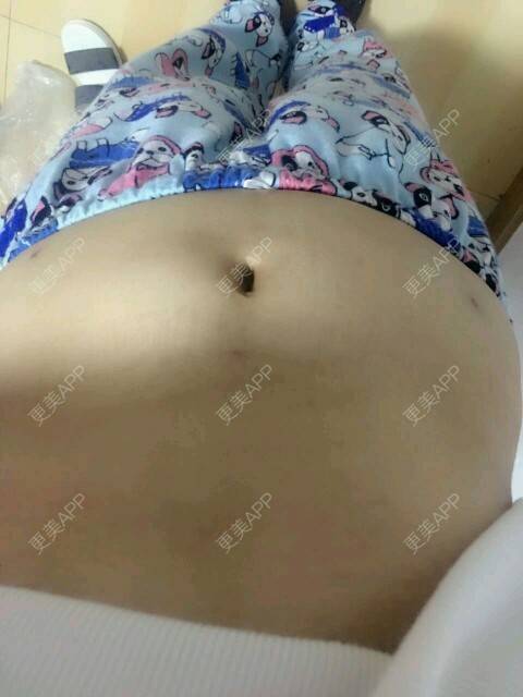 更美 - 金鑫儿的腰腹吸脂经验 | 美购日记 | 腰腹吸脂 | 重庆