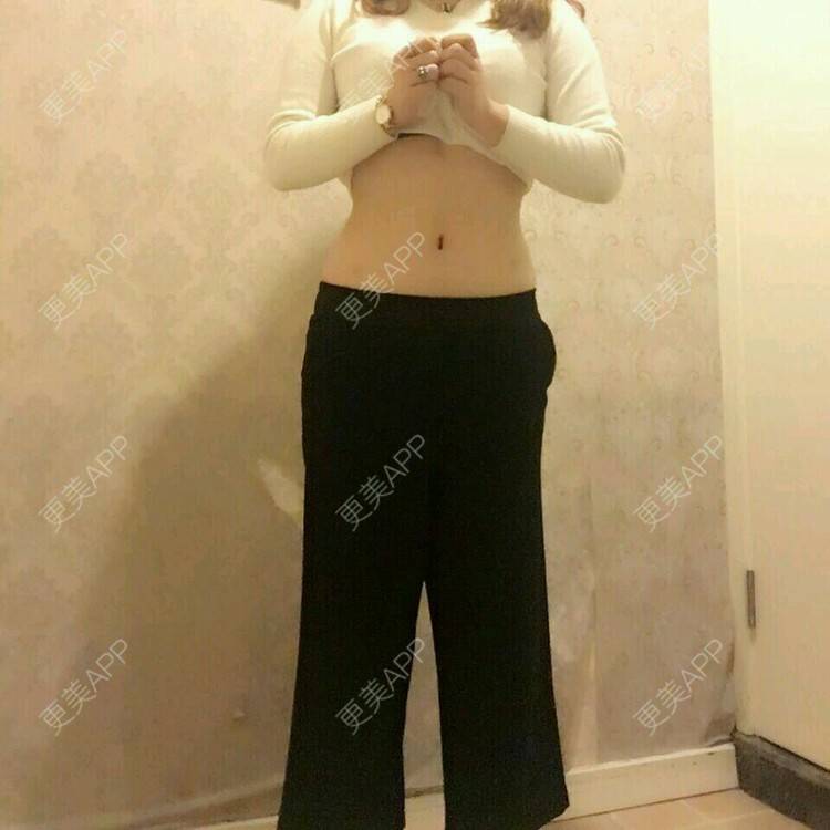 更美 - 金鑫儿的腰腹吸脂经验 | 美购日记 | 腰腹吸脂 | 重庆
