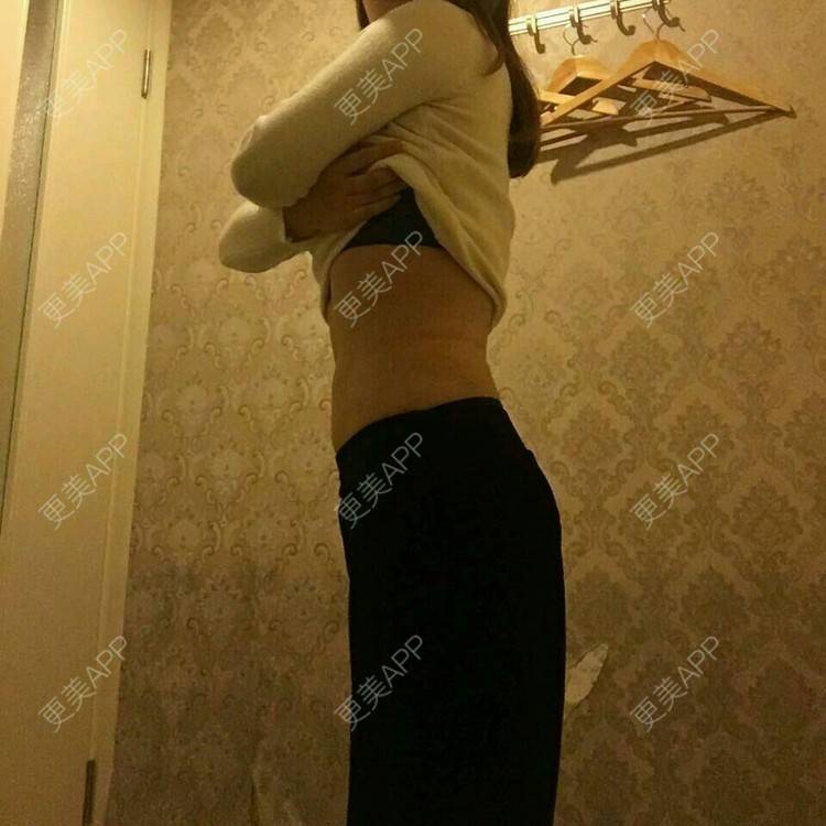 更美 - 金鑫儿的腰腹吸脂经验 | 美购日记 | 腰腹吸脂 | 重庆