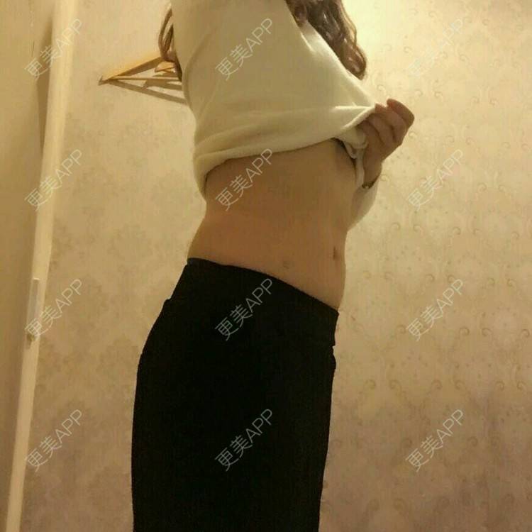 更美 - 金鑫儿的腰腹吸脂经验 | 美购日记 | 腰腹吸脂 | 重庆