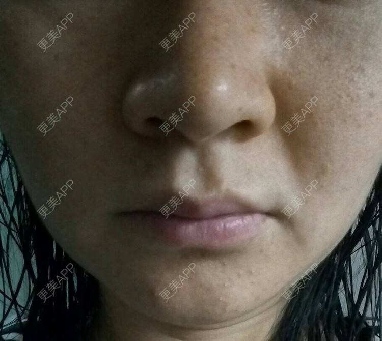 更美 - 更美用户o6b2H5669U的经验 | 嘴角纹 | 郴州