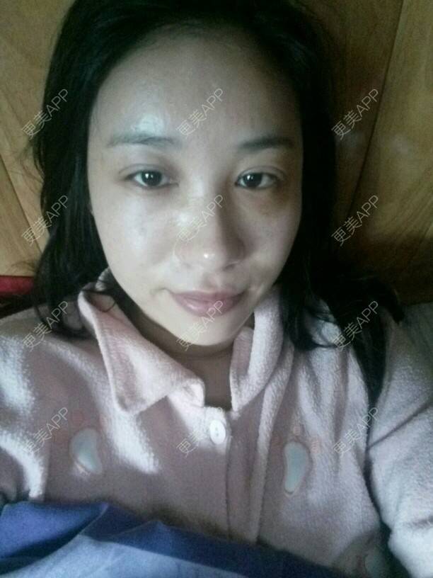 更美 - 更美用户Rgf5OmHSOo的自体脂肪全面部填充经验 | 美购日记 | 自体脂肪全面部填充 | 武汉