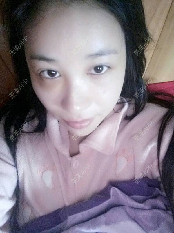 更美 - 更美用户Rgf5OmHSOo的自体脂肪全面部填充经验 | 美购日记 | 自体脂肪全面部填充 | 武汉