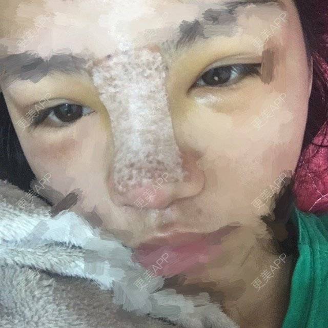 更美 - 嗯啦太可怕的经验 | 硅胶隆鼻子 | 惠州