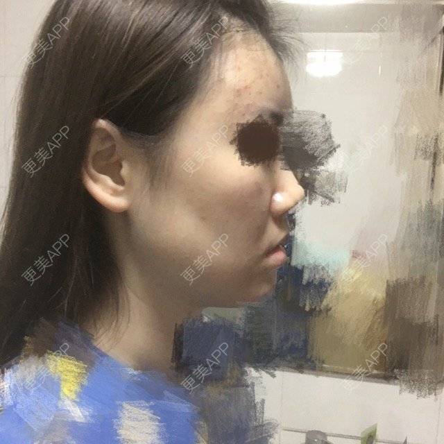更美 - 团子包子的经验 | 在线面诊四 | 面部轮廓 | 改脸型
