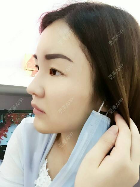 更美 - 李军 医生的自体脂肪全面部填充经验 | 美购日记 | 自体脂肪全面部填充 | 广州