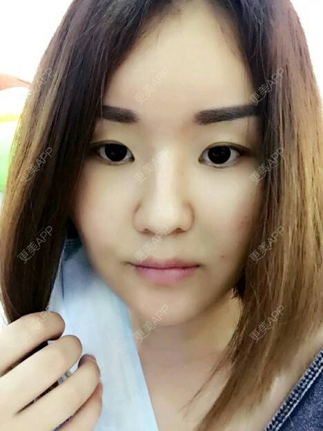 更美 - 李军 医生的自体脂肪全面部填充经验 | 美购日记 | 自体脂肪全面部填充 | 广州