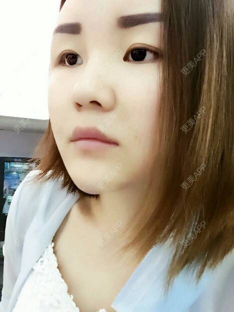 更美 - 李军 医生的自体脂肪全面部填充经验 | 美购日记 | 自体脂肪全面部填充 | 广州