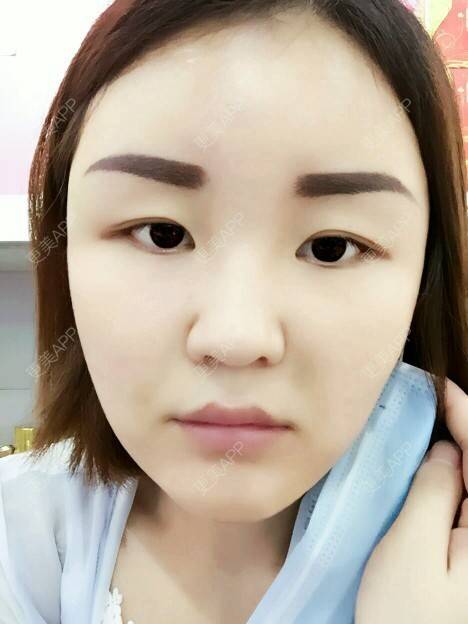 更美 - 李军 医生的自体脂肪全面部填充经验 | 美购日记 | 自体脂肪全面部填充 | 广州