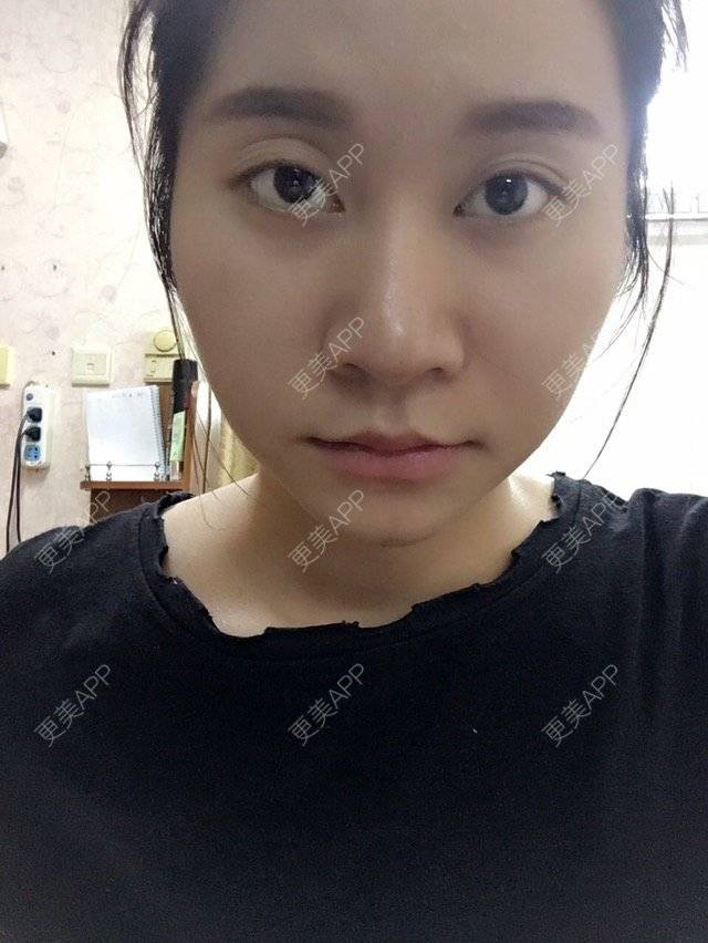 更美 - 权志琳的经验 | 鼻部整形 | 鼻部多项 | 鼻翼鼻头缩小 | 广州