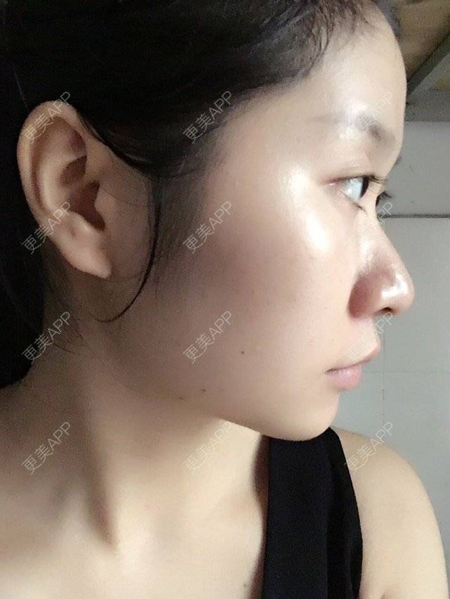 更美 - 权志琳的经验 | 鼻部整形 | 鼻部多项 | 鼻翼鼻头缩小 | 广州