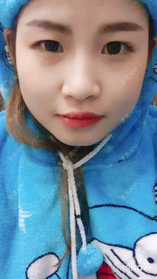 更美 - 清清清啊的经验 | 定点双眼皮 | 益阳