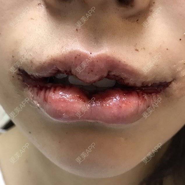 更美 - 你的名字字的m唇成形术日记 | m唇成形术 | 成都 | 嘟嘟唇丰