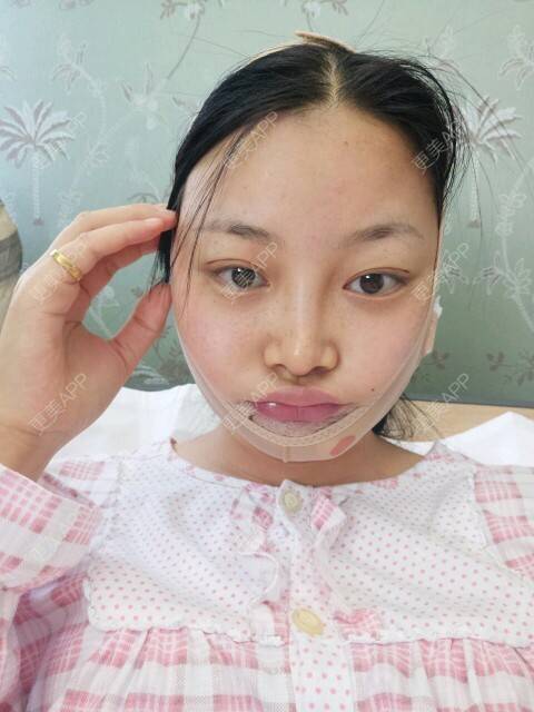 更美 - 爱美美眉的经验 | 祛眼睛脂肪 | 下巴注射物取出 | 美购日记 | 北京