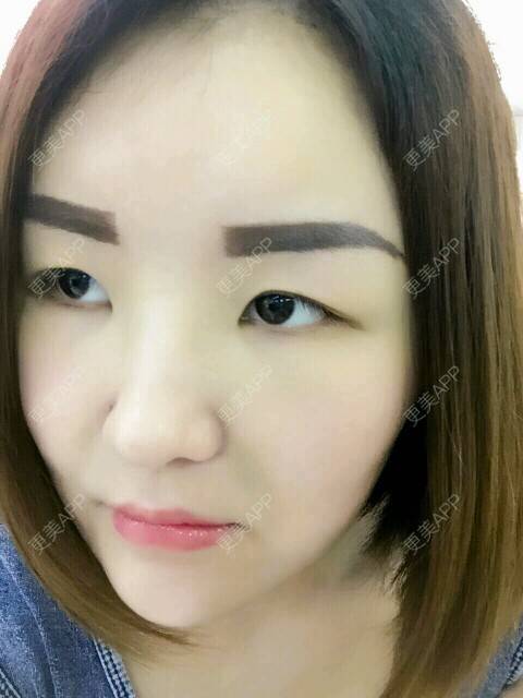 更美 - 李军 医生的自体脂肪全面部填充经验 | 美购日记 | 自体脂肪全面部填充 | 广州