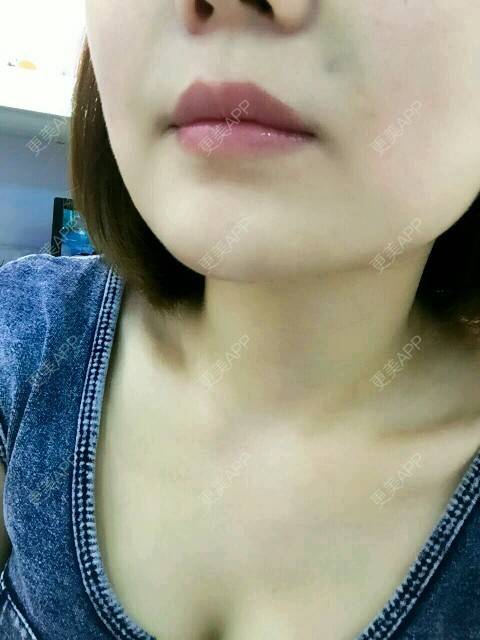 更美 - 李军 医生的自体脂肪全面部填充经验 | 美购日记 | 自体脂肪全面部填充 | 广州