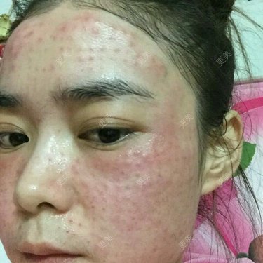 我头天晚上打完水光针后满脸小包第二天满脸红肿胀痛痒小包也没有消
