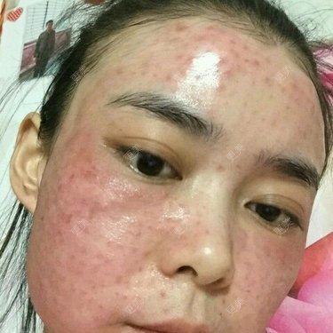 我头天晚上打完水光针后满脸小包第二天满脸红肿胀痛痒小包也没有消